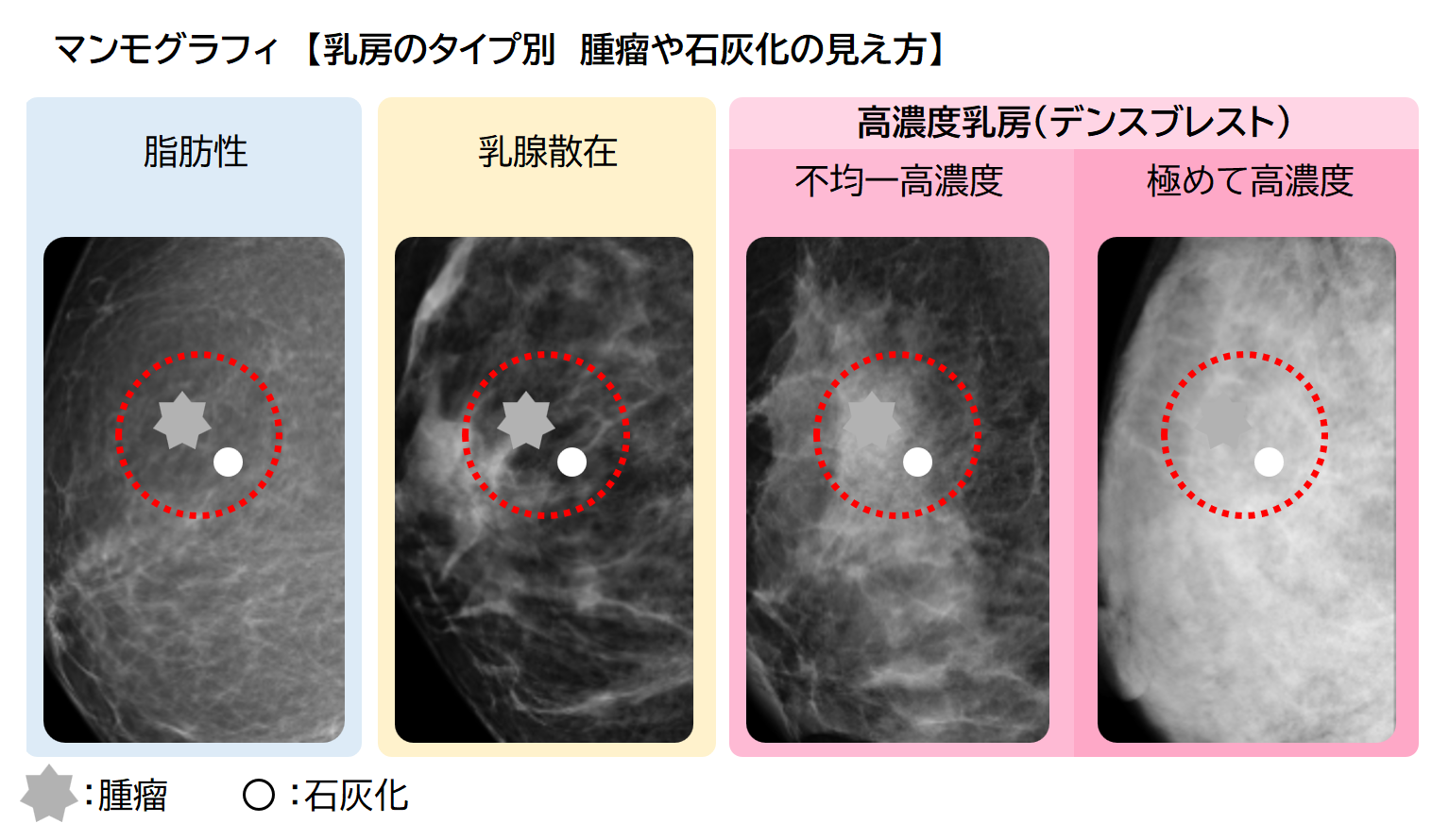 乳がん検診で異常や所見があり、精密検査や再検査となった方へ | 名古屋東女性のクリニック